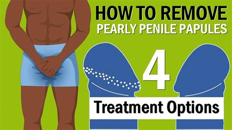 mens pp|pearly penile papules removal cost.